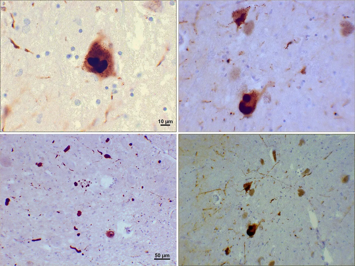 Four micrographs of substantia nigra stained brown for alpha-synuclein: Lewy bodies inside pigmented neurons and thread-like Lewy neurites, on a blue counterstain