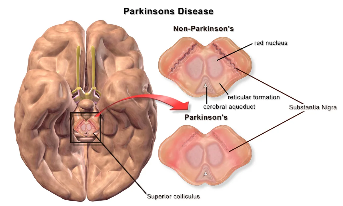 Illustration of the brain from below, with cross-sections of the midbrain: the substantia nigra is a dark band normally and pale in Parkinson's