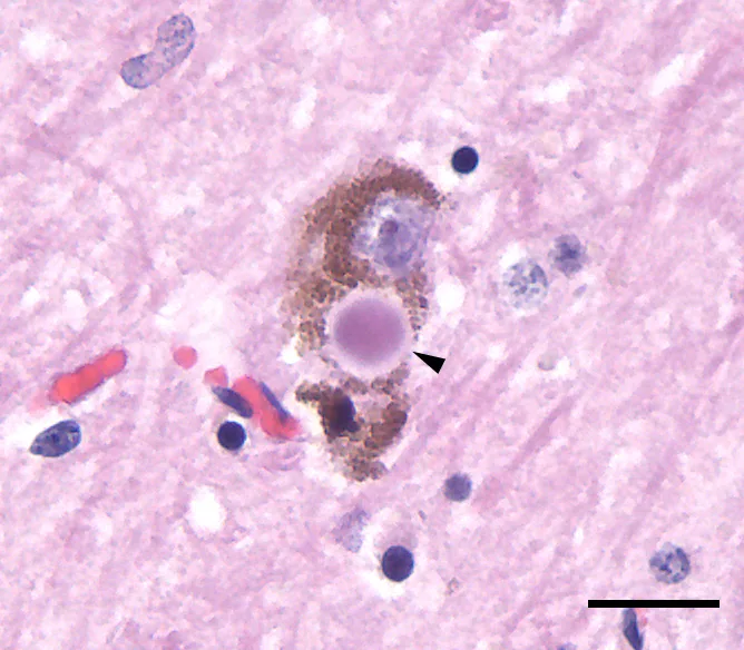 Micrograph of a pigmented neuron in the substantia nigra with a round pink Lewy body, marked by an arrowhead, beside brown neuromelanin